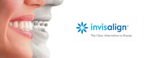 invisalign virginia beach